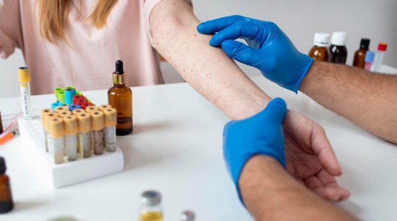 Allergy Treatment industry
